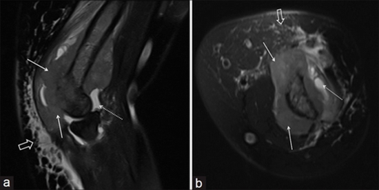 Isolated humeral metastasis in uterine cervical cancer: a rare entity {faces}